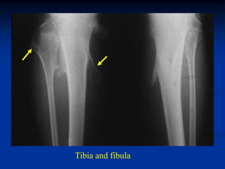 Tibia and fibula
 