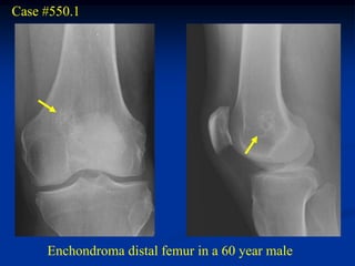 Case #550.1




     Enchondroma distal femur in a 60 year male
 