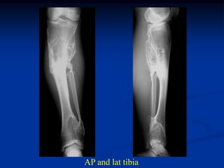 AP and lat tibia
 