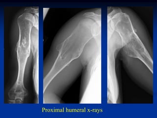 Proximal humeral x-rays
 