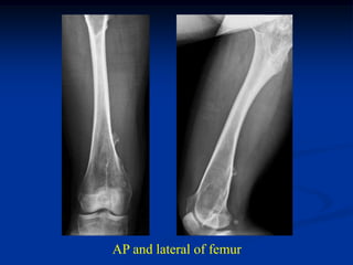 AP and lateral of femur
 