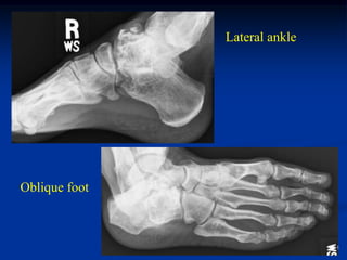 Lateral ankle




Oblique foot
 