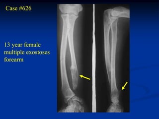 Case #626




13 year female
multiple exostoses
forearm
 