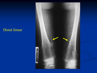 Distal femur
 