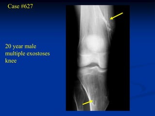 Case #627




20 year male
multiple exostoses
knee
 