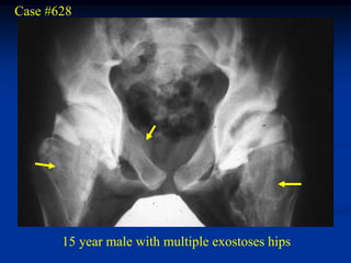 Case #628




       15 year male with multiple exostoses hips
 