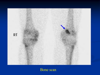 Bone scan
 