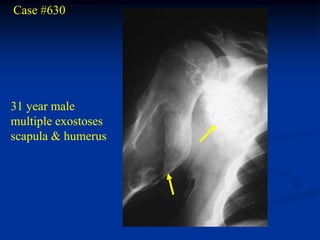Case #630




31 year male
multiple exostoses
scapula & humerus
 