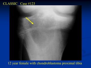 CLASSIC Case #123




  12 year female with chondroblastoma proximal tibia
 