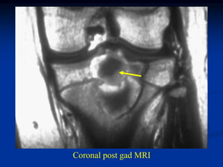 Coronal post gad MRI
 