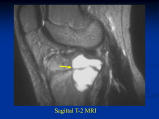 Sagittal T-2 MRI
 