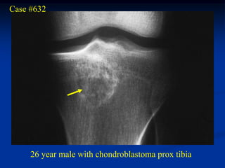 Case #632




     26 year male with chondroblastoma prox tibia
 