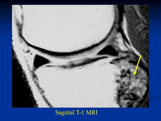 Sagittal T-1 MRI
 