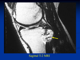 Sagittal T-2 MRI
 
