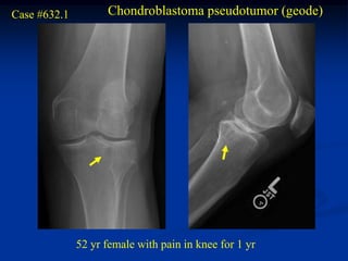 Case #632.1         Chondroblastoma pseudotumor (geode)




              52 yr female with pain in knee for 1 yr
 