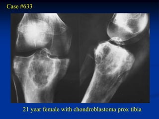 Case #633




     21 year female with chondroblastoma prox tibia
 