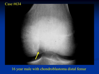 Case #634




   16 year male with chondroblastoma distal femur
 