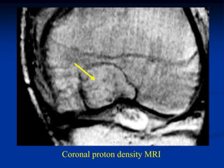 Coronal proton density MRI
 