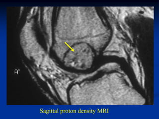 Sagittal proton density MRI
 