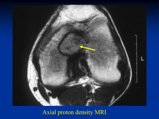 Axial proton density MRI
 