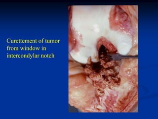 Curettement of tumor
from window in
intercondylar notch


                       tumor
 