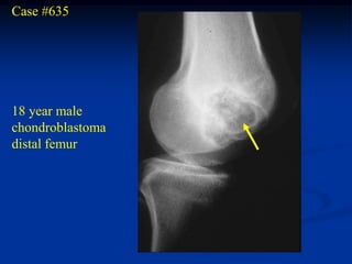 Case #635




18 year male
chondroblastoma
distal femur
 