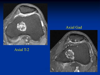 Axial Gad




Axial T-2
 