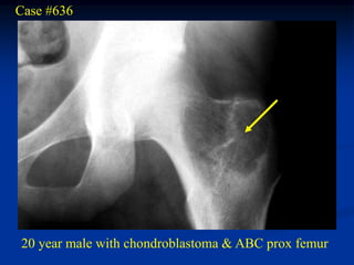 Case #636




20 year male with chondroblastoma & ABC prox femur
 