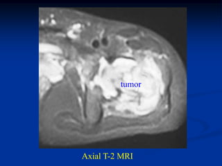 tumor




Axial T-2 MRI
 