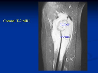Coronal T-2 MRI
                  tumor


                  edema
 