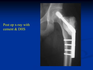 Post op x-ray with
cement & DHS
 