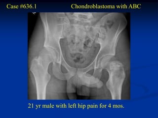 Case #636.1             Chondroblastoma with ABC




       21 yr male with left hip pain for 4 mos.
 
