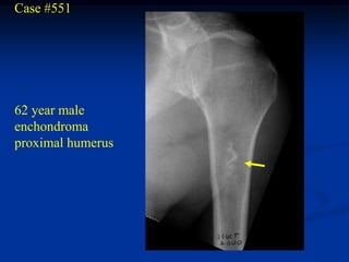 Case #551




62 year male
enchondroma
proximal humerus
 