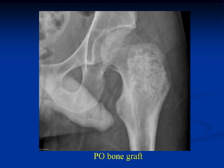 PO bone graft
 