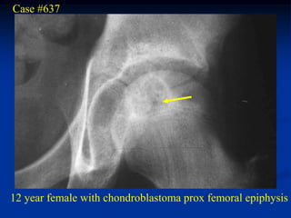 Case #637




12 year female with chondroblastoma prox femoral epiphysis
 