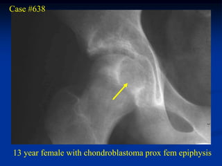 Case #638




13 year female with chondroblastoma prox fem epiphysis
 