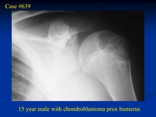 Case #639




    15 year male with chondroblastoma prox humerus
 