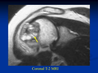 Coronal T-2 MRI
 