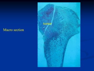 tumor
Macro section
 
