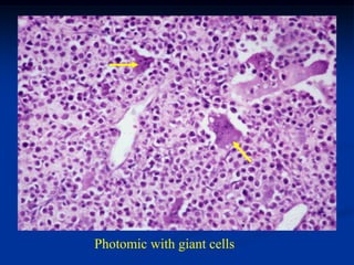 Photomic with giant cells
 