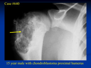 Case #640




 15 year male with chondroblastoma proximal humerus
 