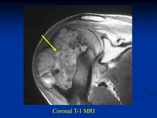 Coronal T-1 MRI
 