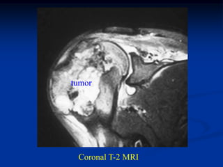 tumor




 Coronal T-2 MRI
 