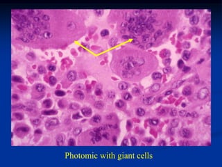 Photomic with giant cells
 