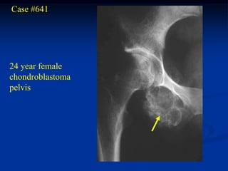 Case #641




24 year female
chondroblastoma
pelvis
 
