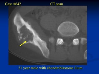 Case #642                 CT scan




       21 year male with chondroblastoma ilium
 