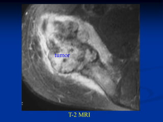 tumor




    T-2 MRI
 