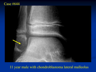 Case #644




   11 year male with chondroblastoma lateral malleolus
 