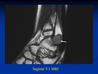 Sagittal T-1 MRI
 