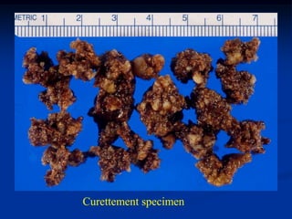 Curettement specimen
 